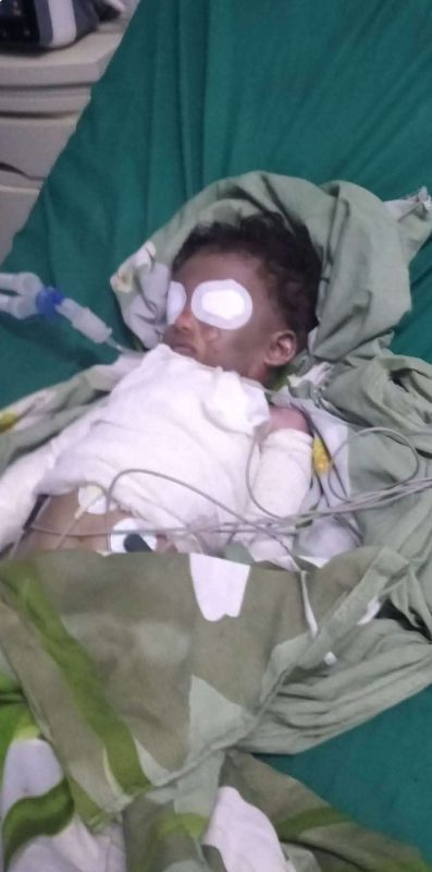 عدن.. وفاة طفل متأثرا بحروق أصيب بها في حريق منزله بخور مكسر